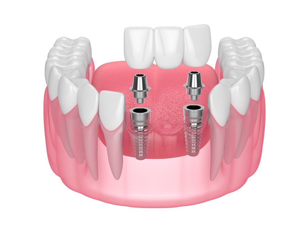 Why Dental Implants Offer the Best Tooth Replacement in Carrollton TX